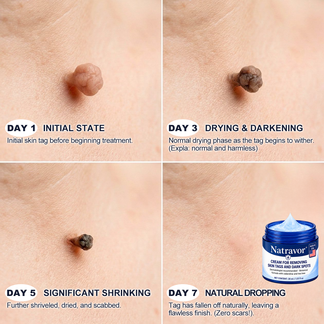 Natravor® 7-𝐃𝐚𝐲 𝐒𝐤𝐢𝐧 𝐓𝐚𝐠 & 𝐒𝐩𝐨𝐭 𝐄𝐫𝐚𝐬𝐞𝐫 𝐂𝐫𝐞𝐚𝐦 (Zero Pain, Zero 𝐒𝐜𝐚𝐫𝐬 Formula) 💎d
